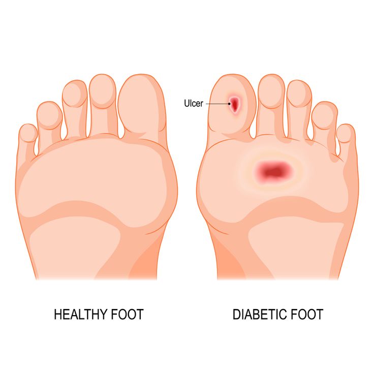 How to Diagnose and Manage Diabetic Foot Ulcers