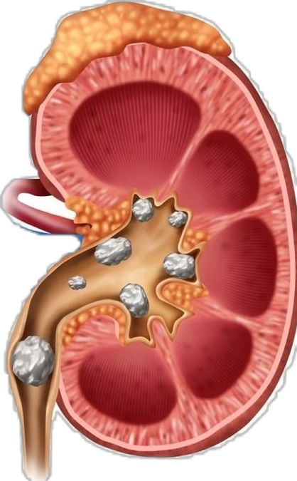 How to Treat Kidney Stones Without Surgery Effectively