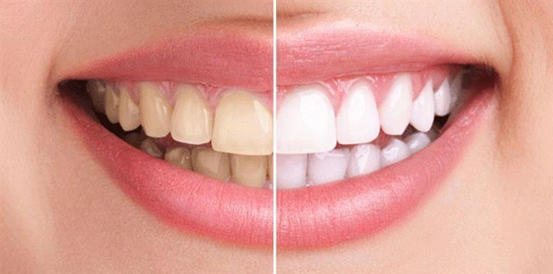5 Common Cosmetic Dentistry Procedures That Help Improve Your Smile