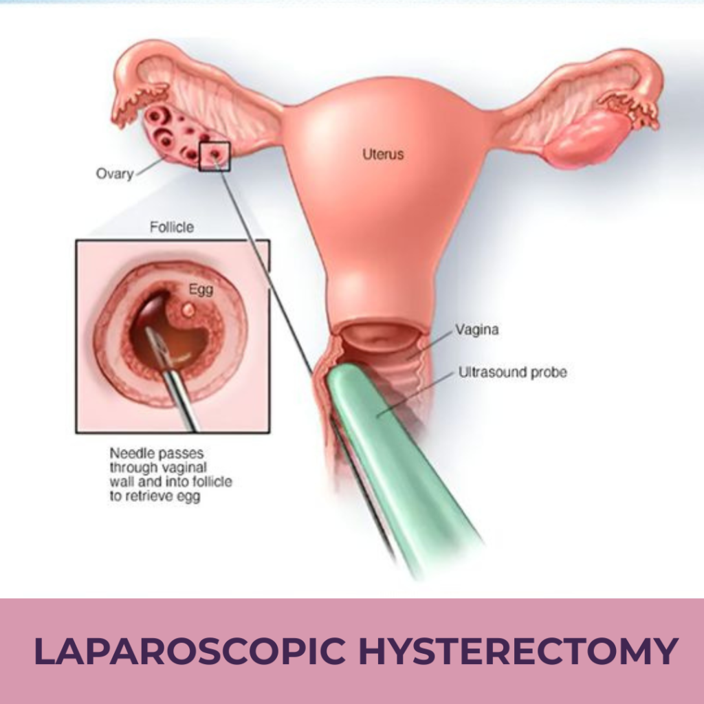Laparoscopic Hysterectomy: Procedure, Benefits, Recovery
